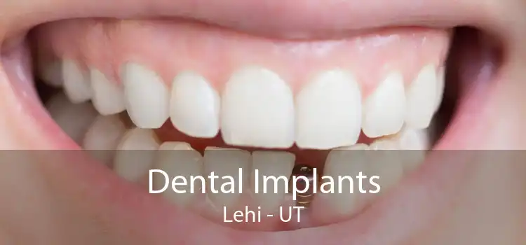 Dental Implants Lehi - UT