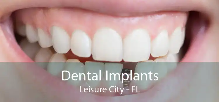 Dental Implants Leisure City - FL