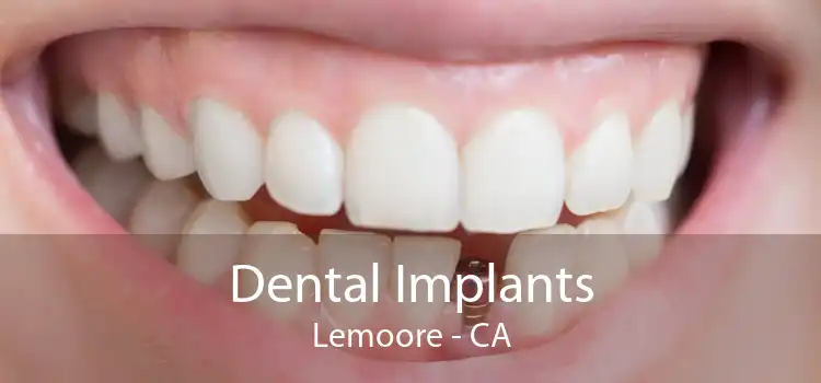 Dental Implants Lemoore - CA