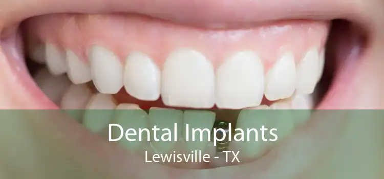 Dental Implants Lewisville - TX