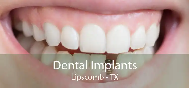 Dental Implants Lipscomb - TX