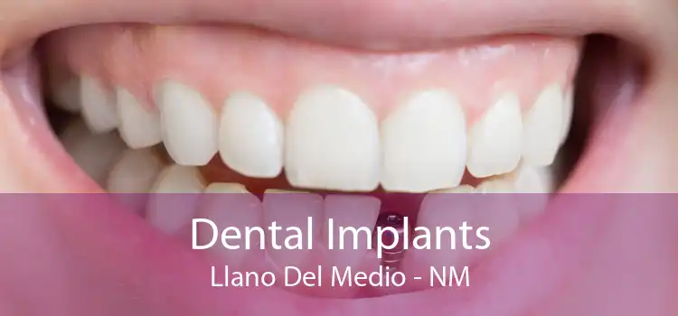 Dental Implants Llano Del Medio - NM
