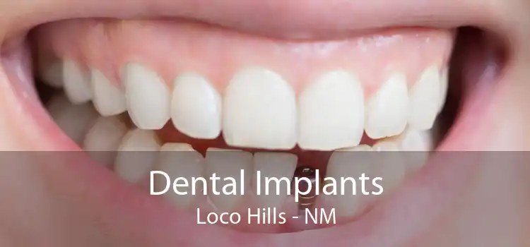 Dental Implants Loco Hills - NM