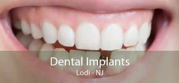 Dental Implants Lodi - NJ