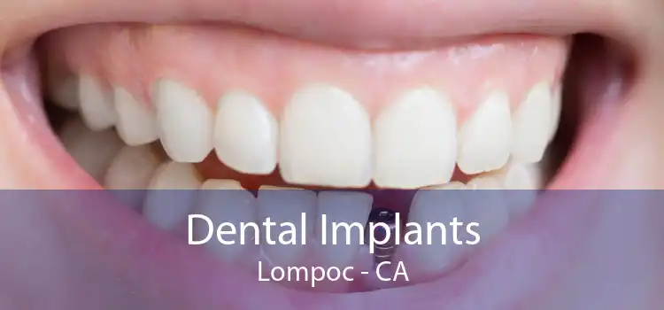 Dental Implants Lompoc - CA