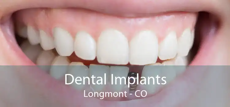 Dental Implants Longmont - CO