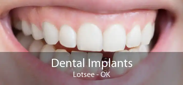 Dental Implants Lotsee - OK