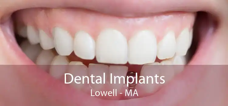 Dental Implants Lowell - MA