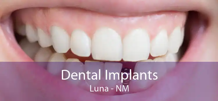 Dental Implants Luna - NM