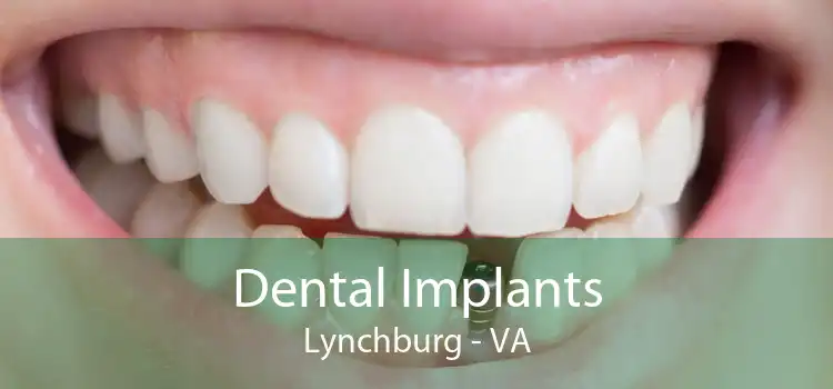 Dental Implants Lynchburg - VA