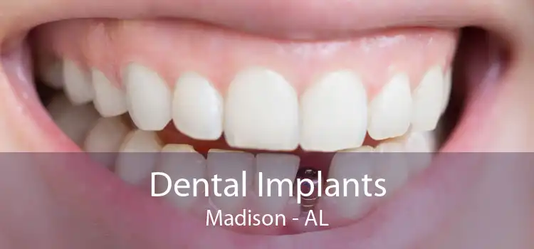 Dental Implants Madison - AL
