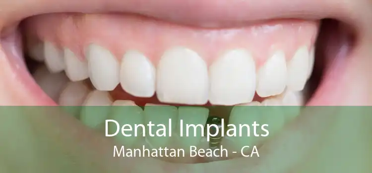 Dental Implants Manhattan Beach - CA