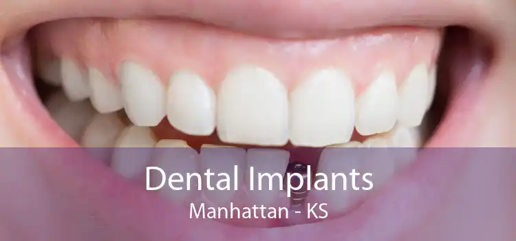 Dental Implants Manhattan - KS