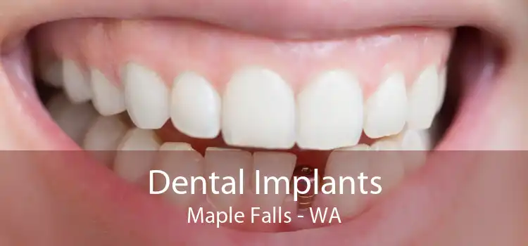 Dental Implants Maple Falls - WA