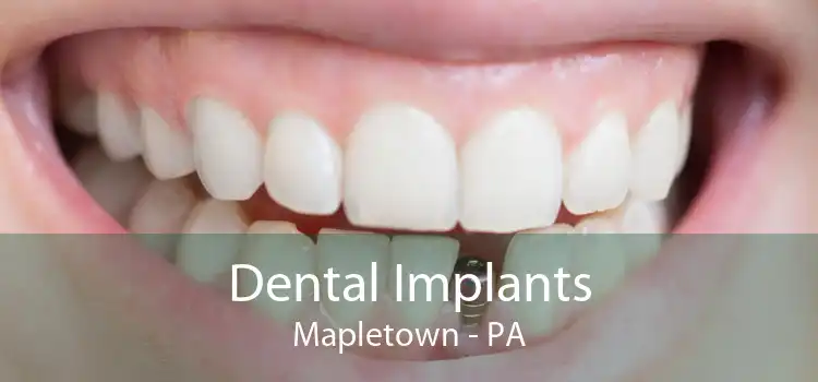 Dental Implants Mapletown - PA
