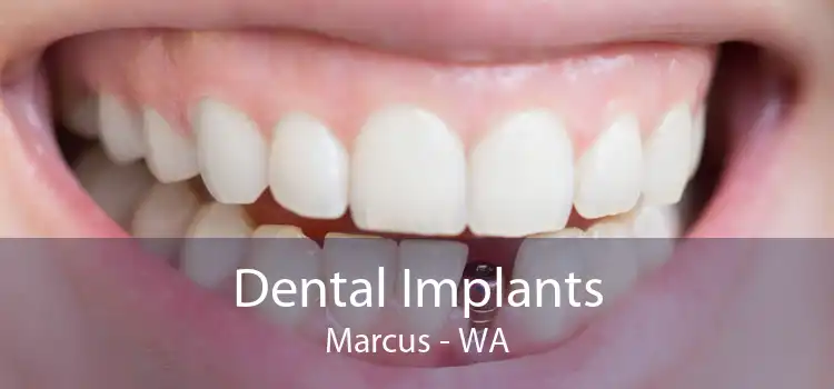 Dental Implants Marcus - WA