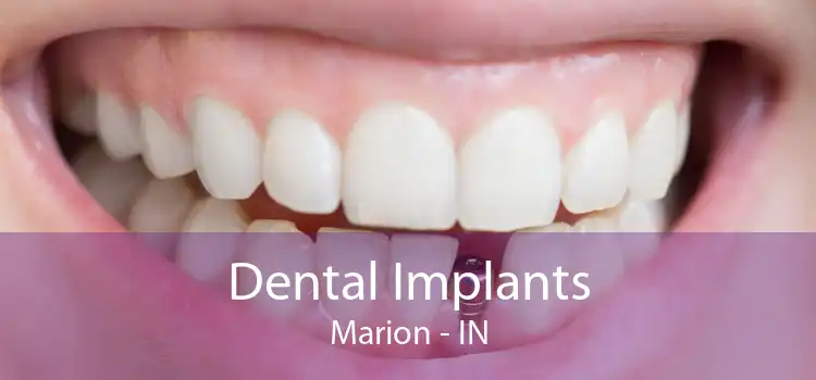 Dental Implants Marion - IN