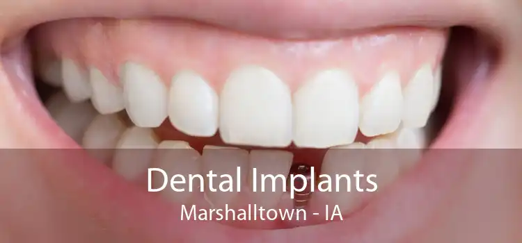 Dental Implants Marshalltown - IA
