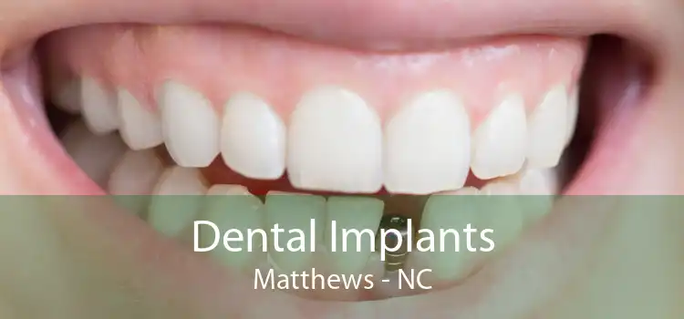 Dental Implants Matthews - NC