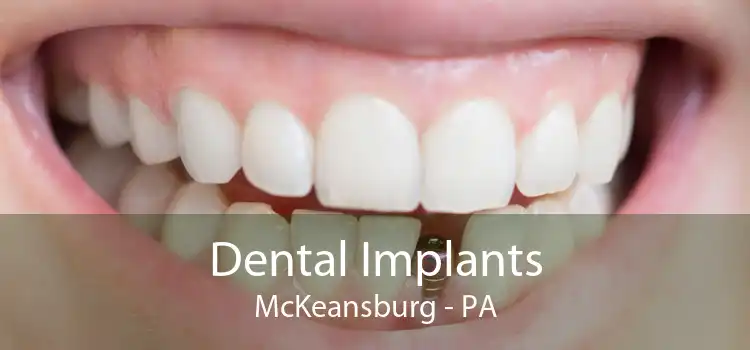 Dental Implants McKeansburg - PA