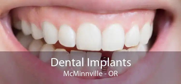 Dental Implants McMinnville - OR