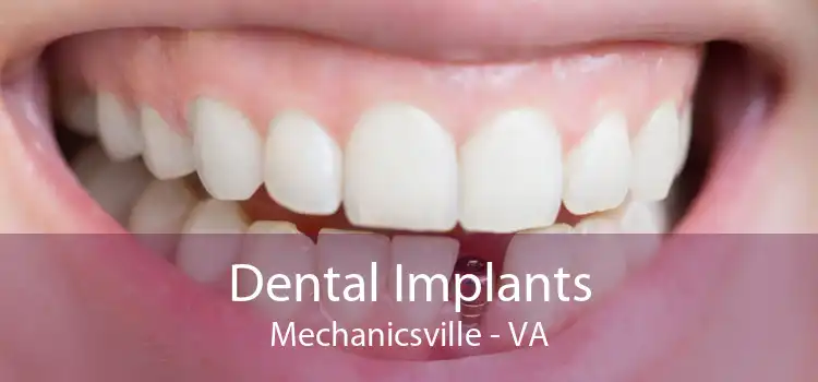 Dental Implants Mechanicsville - VA