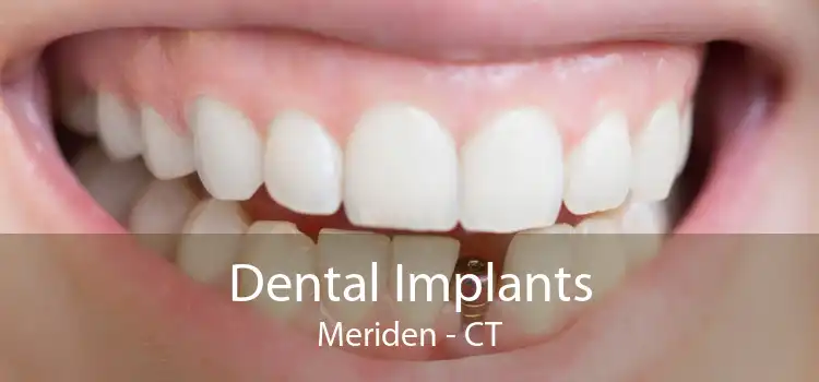 Dental Implants Meriden - CT