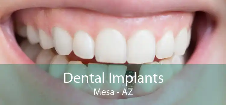 Dental Implants Mesa - AZ