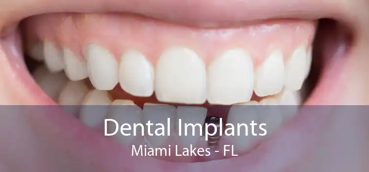 Dental Implants Miami Lakes - FL