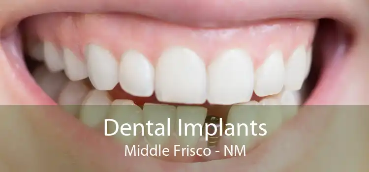 Dental Implants Middle Frisco - NM