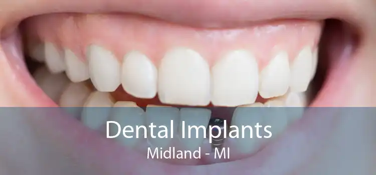 Dental Implants Midland - MI