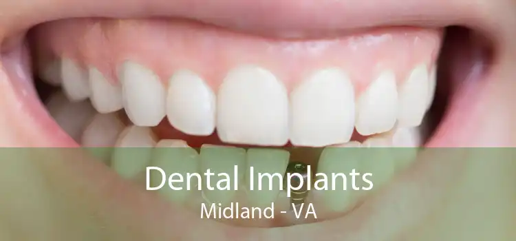 Dental Implants Midland - VA