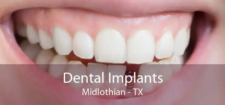Dental Implants Midlothian - TX