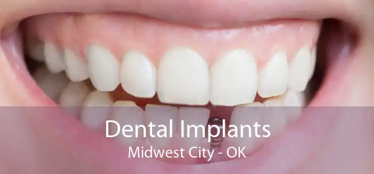 Dental Implants Midwest City - OK