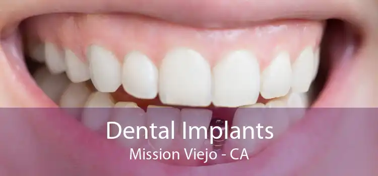 Dental Implants Mission Viejo - CA
