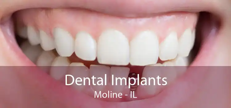 Dental Implants Moline - IL