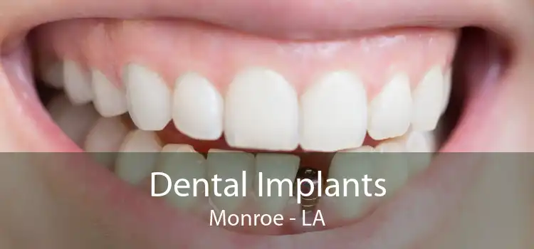 Dental Implants Monroe - LA