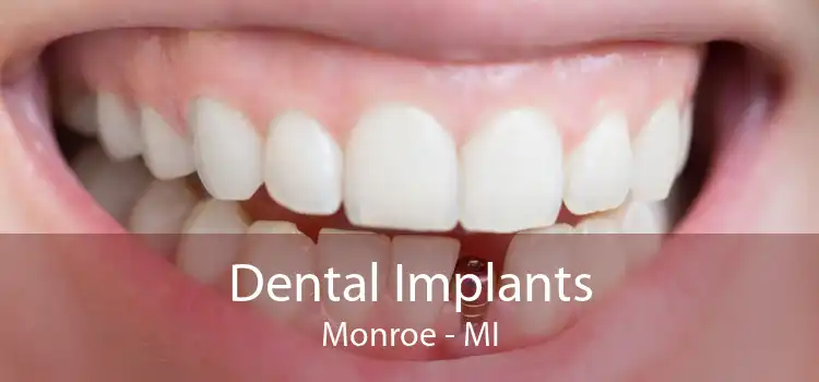 Dental Implants Monroe - MI