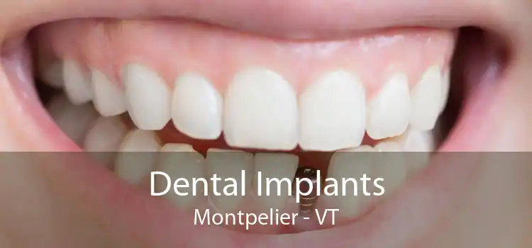 Dental Implants Montpelier - VT