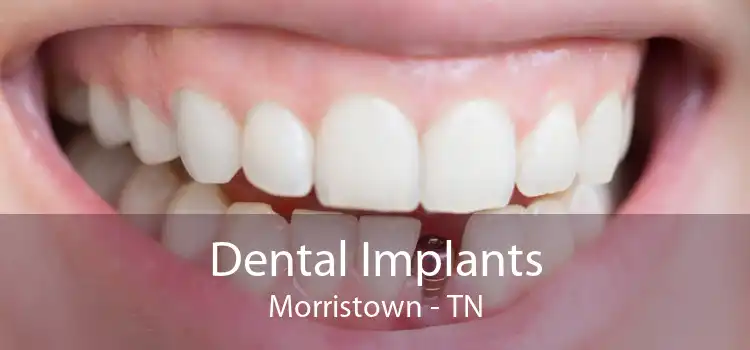 Dental Implants Morristown - TN