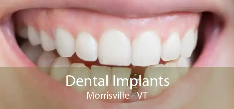 Dental Implants Morrisville - VT