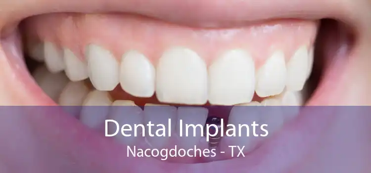 Dental Implants Nacogdoches - TX