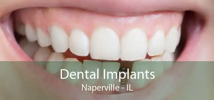 Dental Implants Naperville - IL
