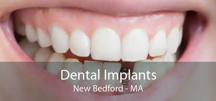 Dental Implants New Bedford - MA