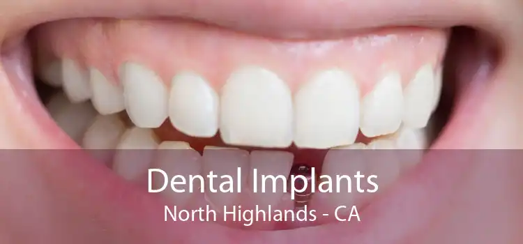 Dental Implants North Highlands - CA