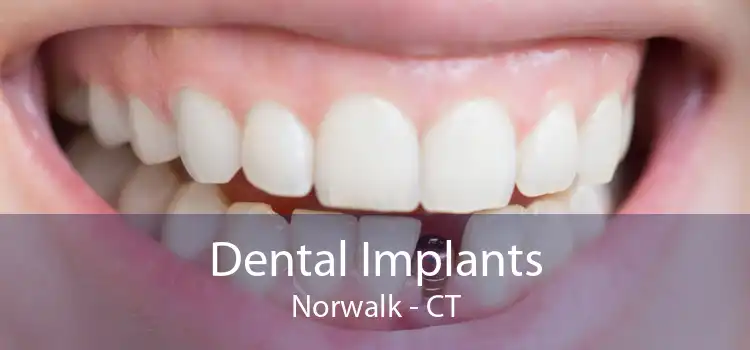 Dental Implants Norwalk - CT