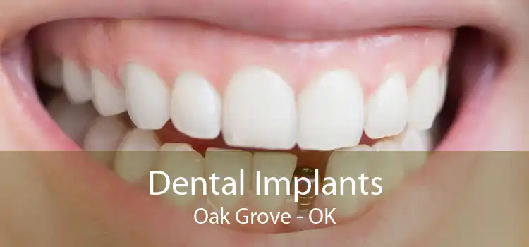 Dental Implants Oak Grove - OK