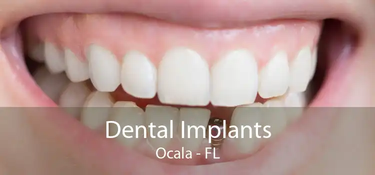 Dental Implants Ocala - FL
