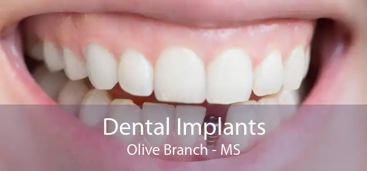 Dental Implants Olive Branch - MS