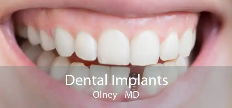 Dental Implants Olney - MD
